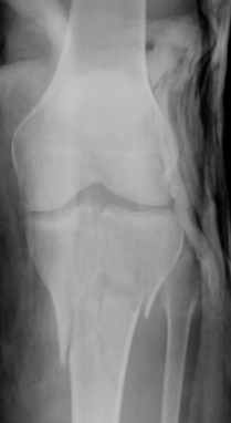 Schatzker 6 Proximal Tibia